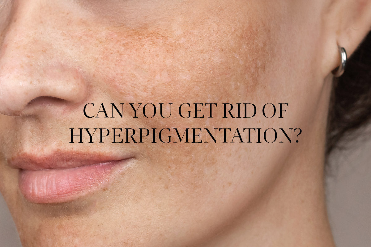 No, hyperpigmentation isn’t impossible to minimise